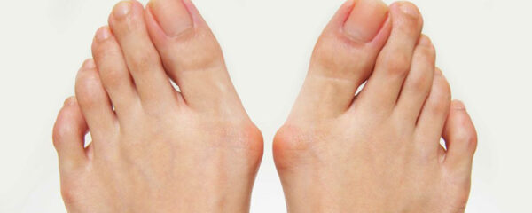 Hallux valgus