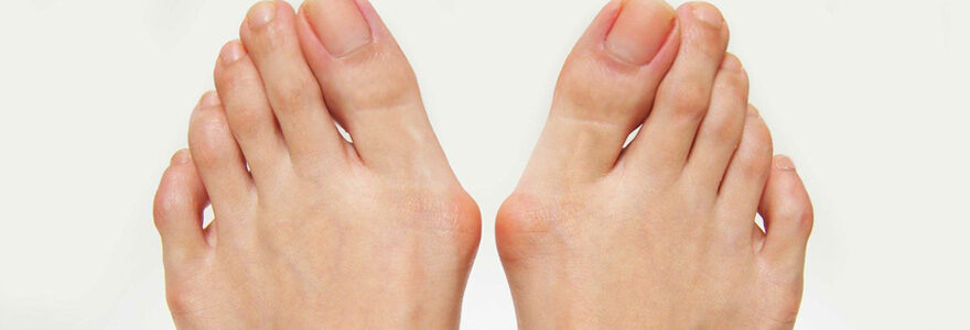 Hallux valgus