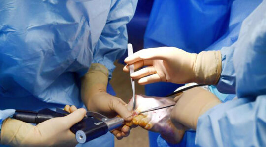 chirurgie mini-invasive du pied