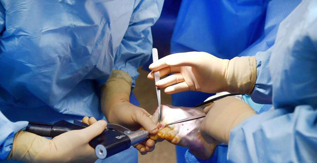 chirurgie mini-invasive du pied